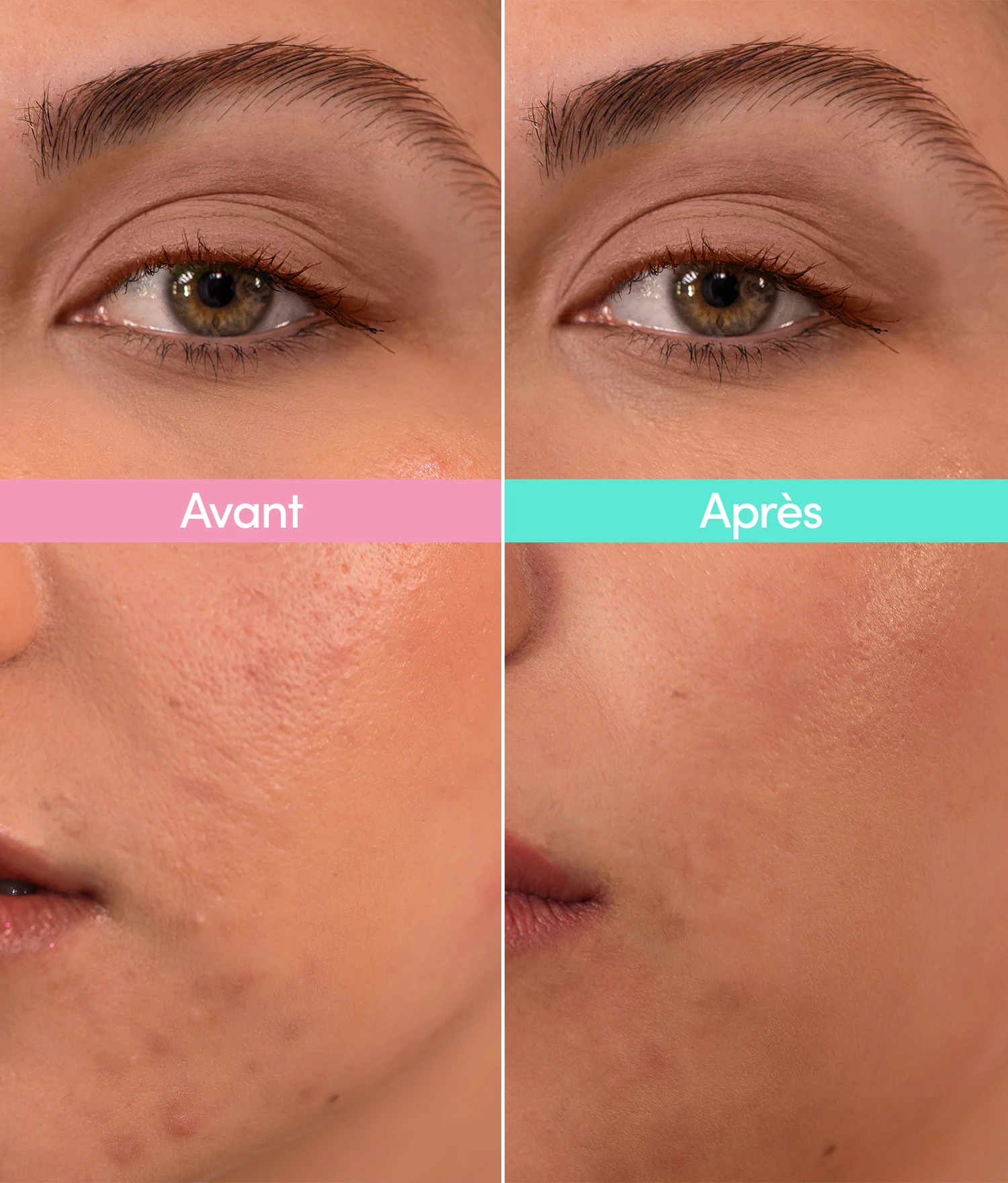 Routine Bye Bye Boutons 2 Routine Bye Bye Boutons - Image 2